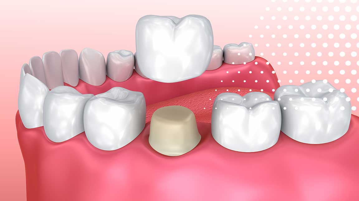 Dental Crowns in Oak Park, IL