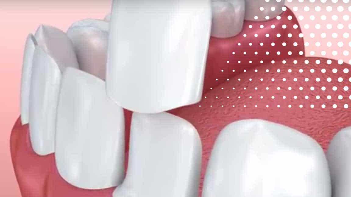 Dental Veneers in Oak Park, IL