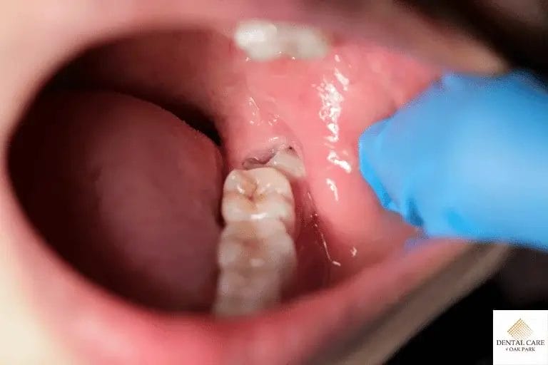 Close-up of healing wisdom tooth extraction site inside the mouth..